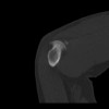 SPORK, NICO - 22.03.1976 - 02.08.2022 - CT obere Extremität - 17:59:07
